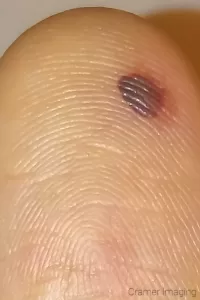 photo of a small blood blister on finger pad